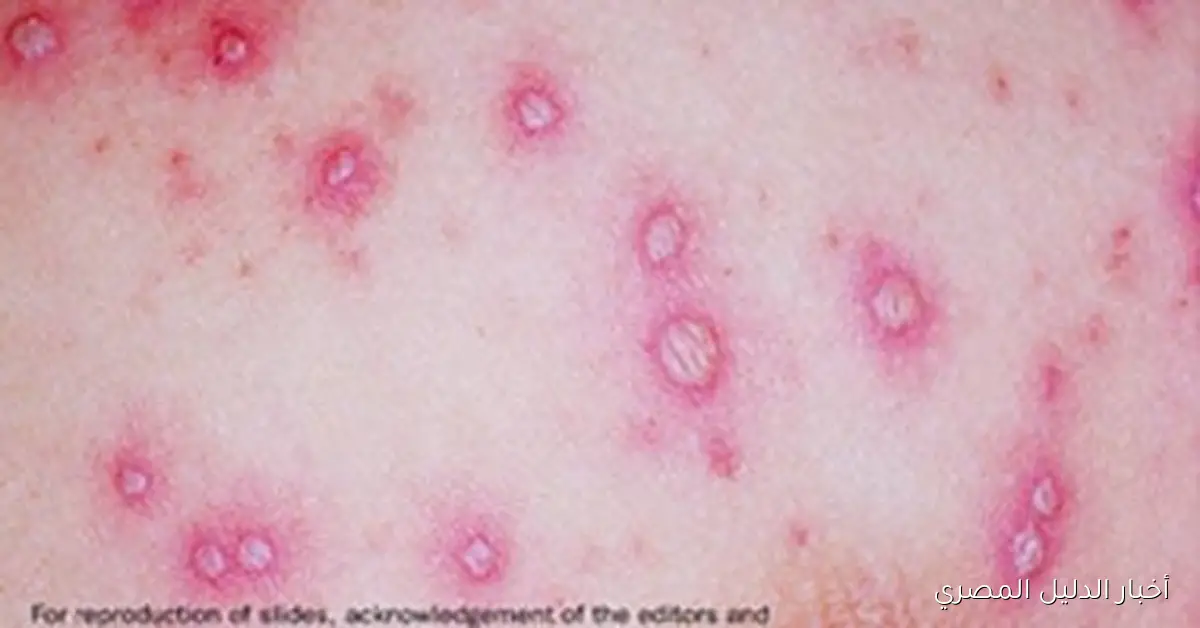 ارتفاع عدد إصابات الجدرى المائى بين طلاب مدرسة في المنوفية إلى 18 حالة