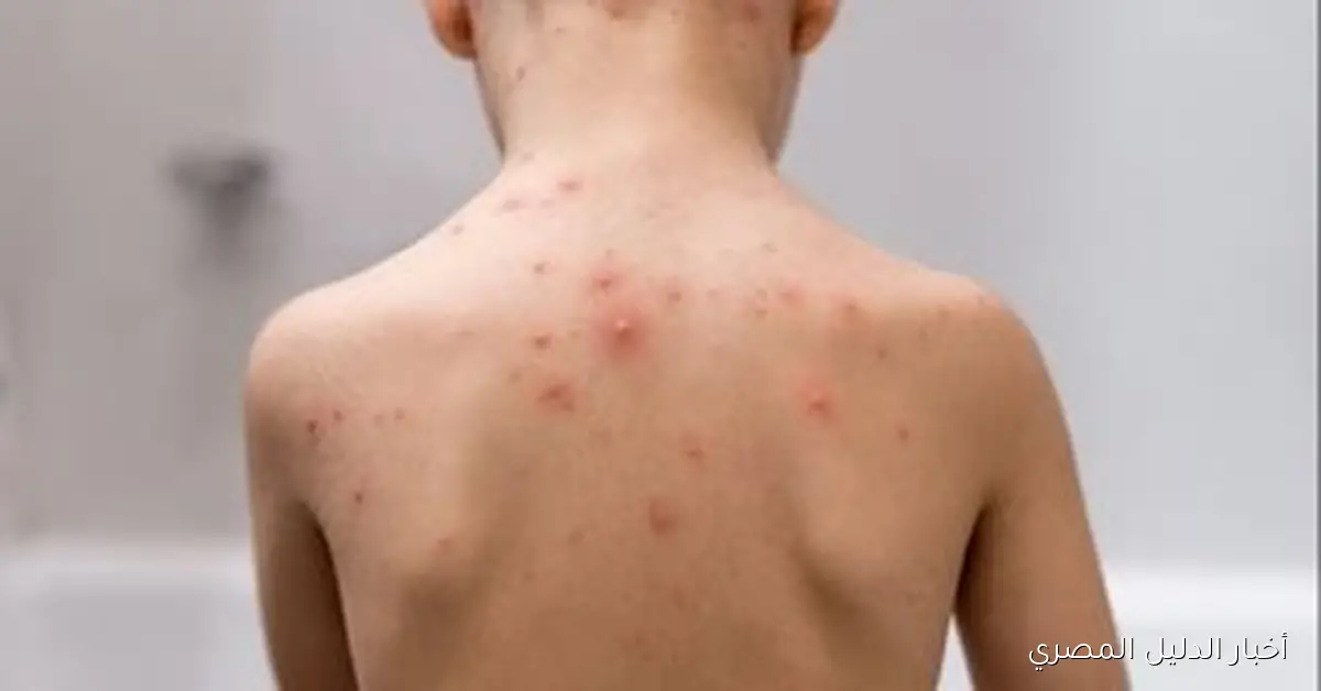 فحص طبي شامل لجميع طلاب مدرسة في الباجور بعد إصابة 24 منهم بالجدرى المائى