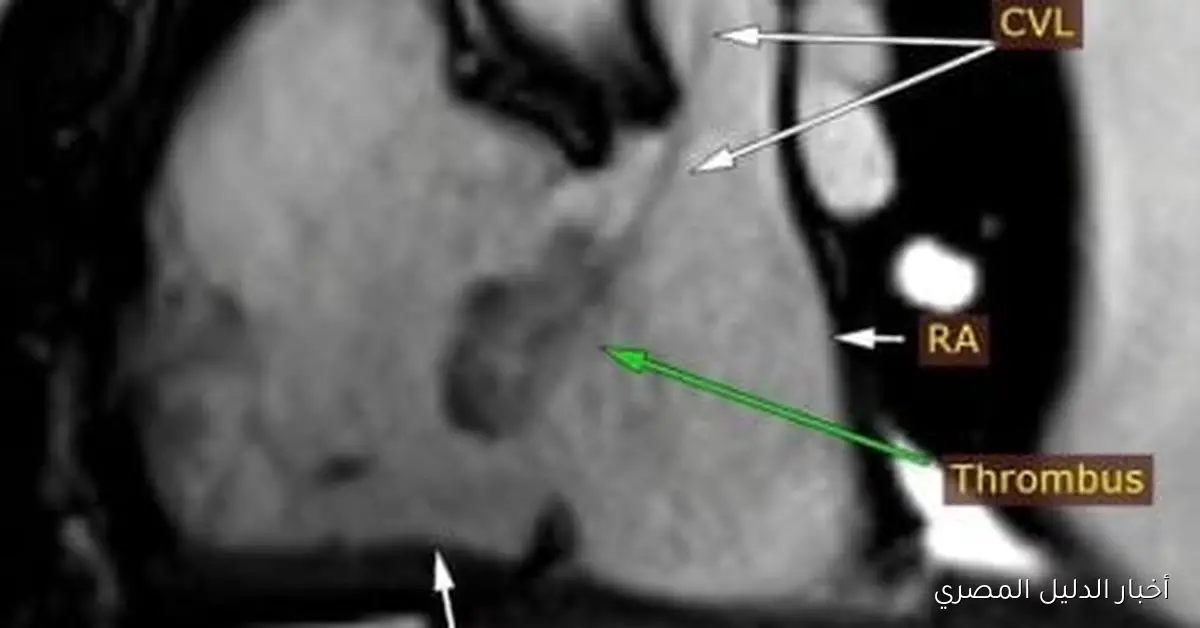 مستشفى سوهاج الجامعي الجديد يكتشف حالة نادرة لمريض ويقدم علاجًا فوريًا لها