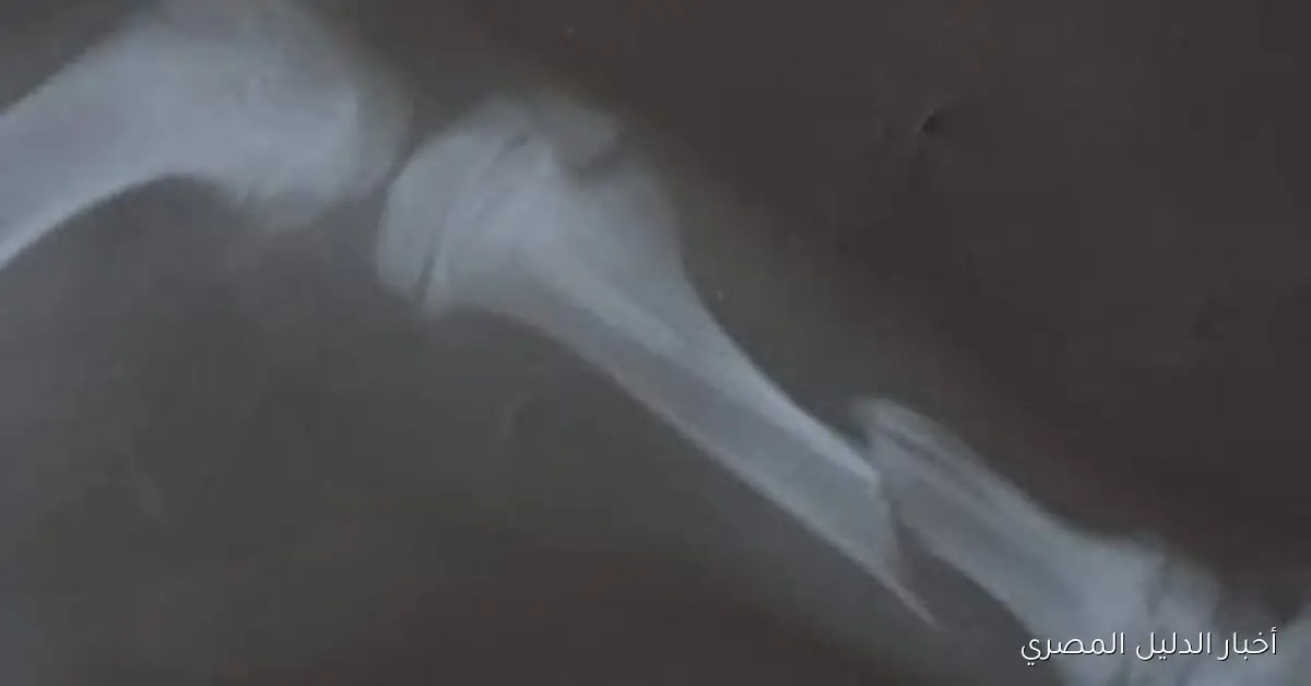 نجاح جراحة لتثبيت عظام ساق جرو عمره 3 أشهر بعد تعرضه لحادث سير في الغربية