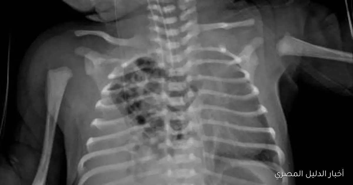 <p><strong>نجاح جراحة نادرة في مستشفى زاوية الناعورة تنقذ حياة طفل من فتق بالحجاب الحاجز</strong></p>