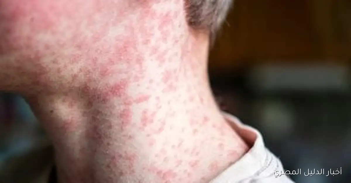 وزارة الصحة الإسرائيلية: تسجيل 1880 حالة إصابة بالحصبة وآلاف الحالات غير المبلغ عنها